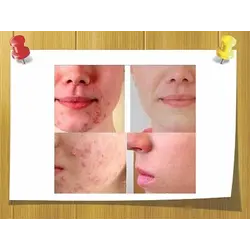 Анти Акне и противовоспалительные