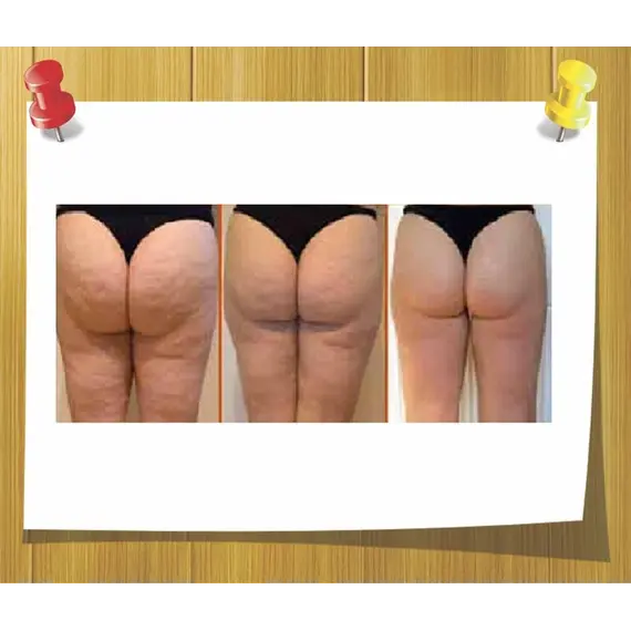 Антицеллюлитный комплекс Lipofirm LWC